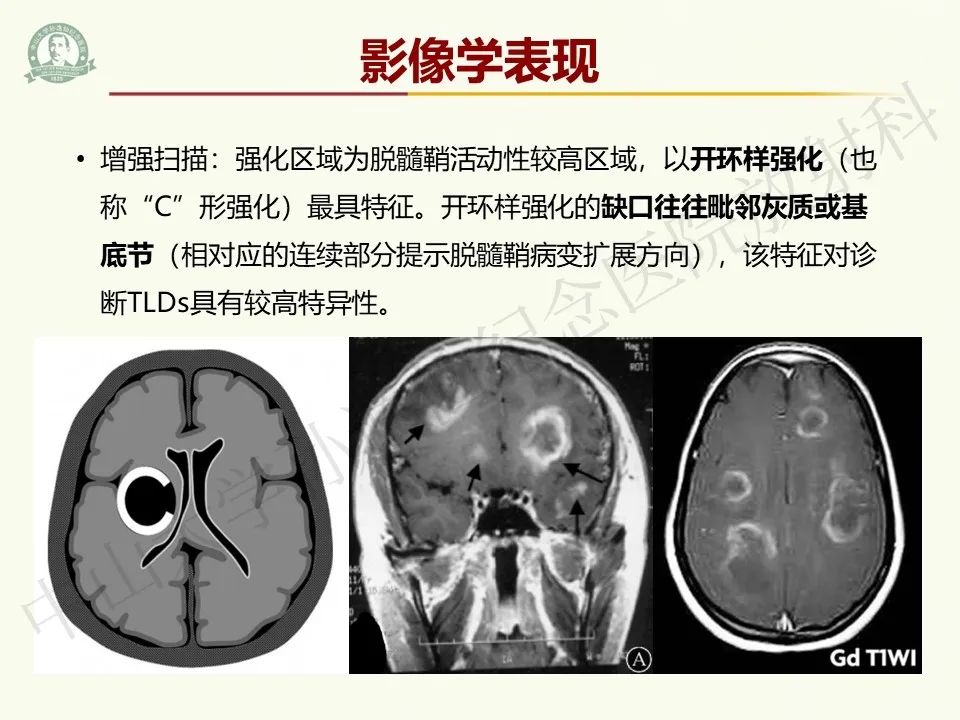影像PPT - 【病例】脑干脱髓鞘假瘤1例CT及MR影像-19