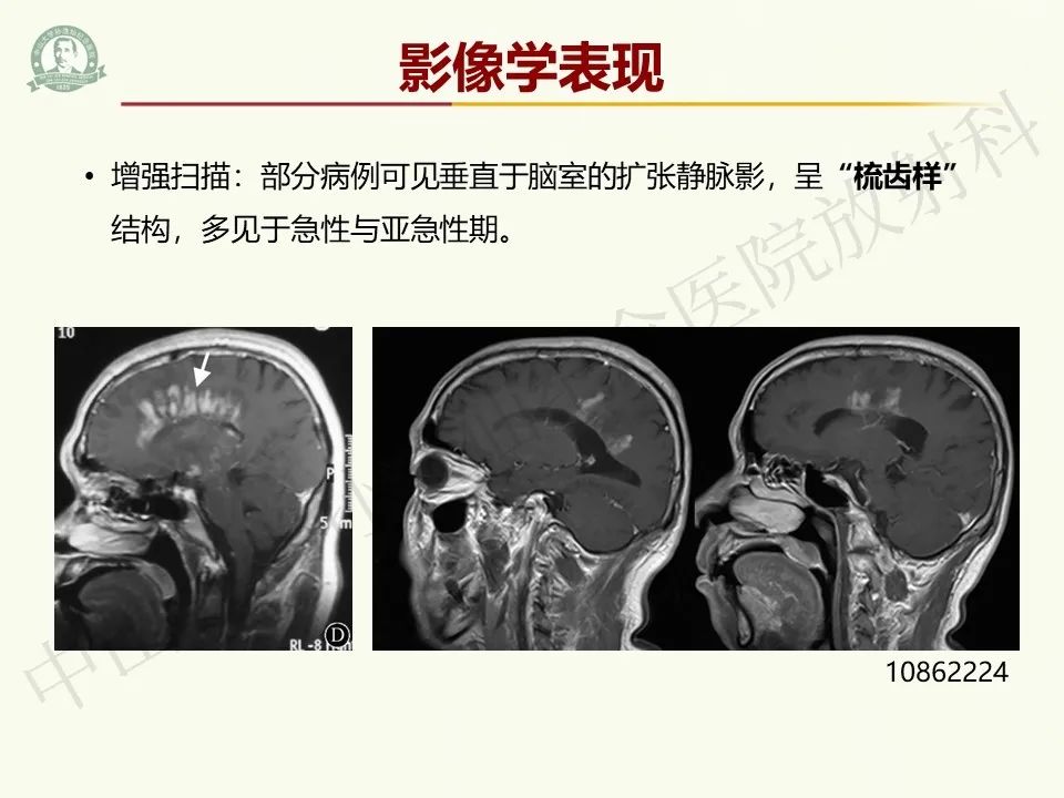 影像PPT - 【病例】脑干脱髓鞘假瘤1例CT及MR影像-20