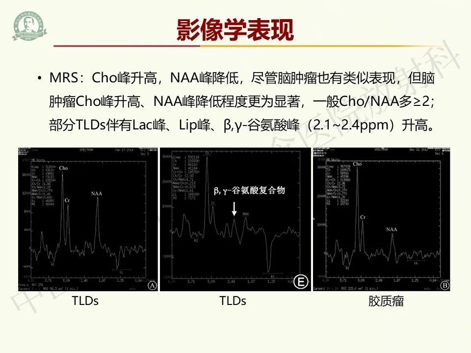 影像PPT - 【病例】脑干脱髓鞘假瘤1例CT及MR影像-21