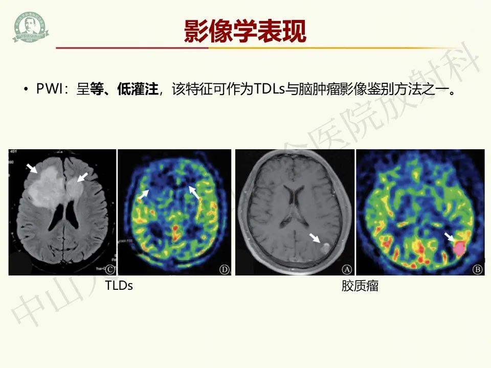 影像PPT - 【病例】脑干脱髓鞘假瘤1例CT及MR影像-22