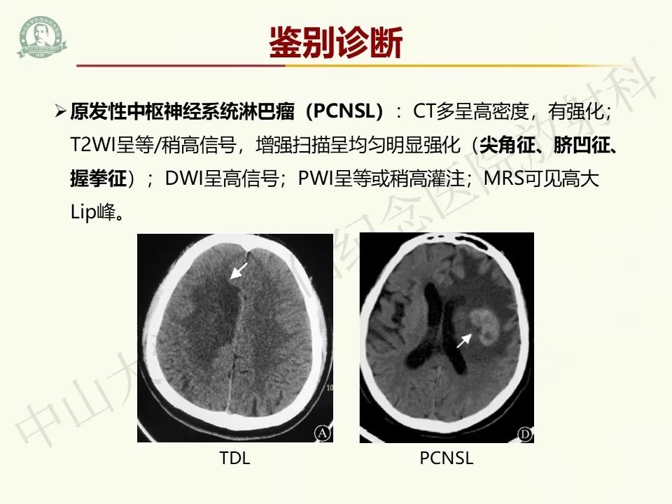 影像PPT - 【病例】脑干脱髓鞘假瘤1例CT及MR影像-26