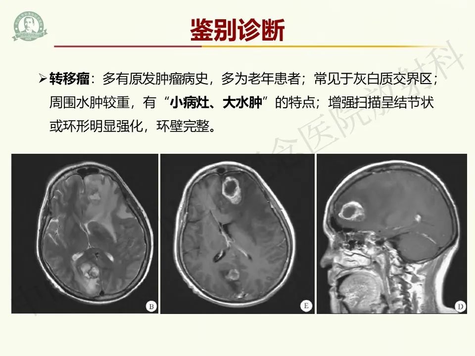 影像PPT - 【病例】脑干脱髓鞘假瘤1例CT及MR影像-29