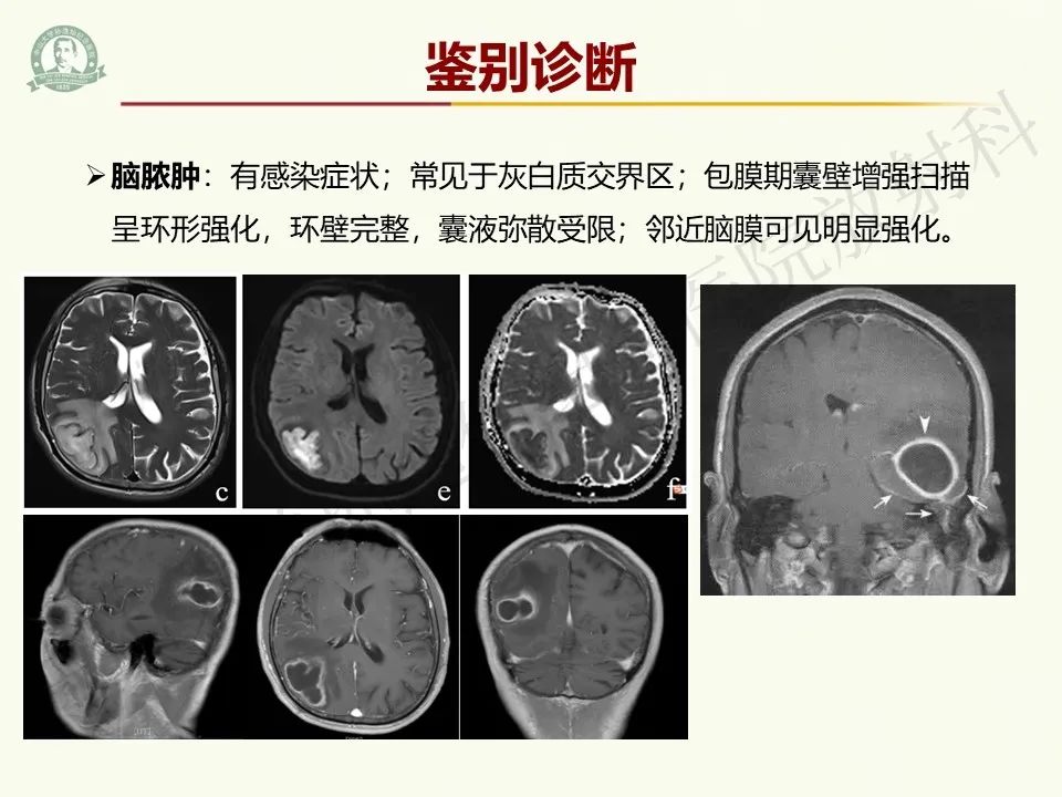 影像PPT - 【病例】脑干脱髓鞘假瘤1例CT及MR影像-30