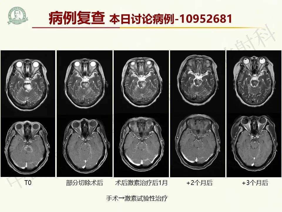 影像PPT - 【病例】脑干脱髓鞘假瘤1例CT及MR影像-34