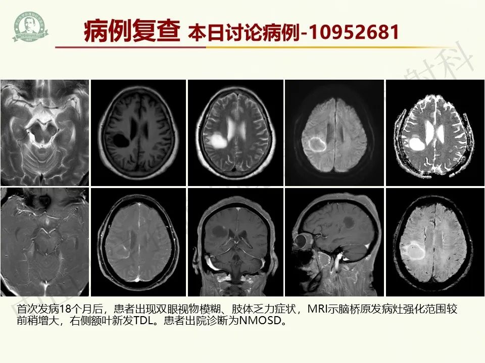 影像PPT - 【病例】脑干脱髓鞘假瘤1例CT及MR影像-35
