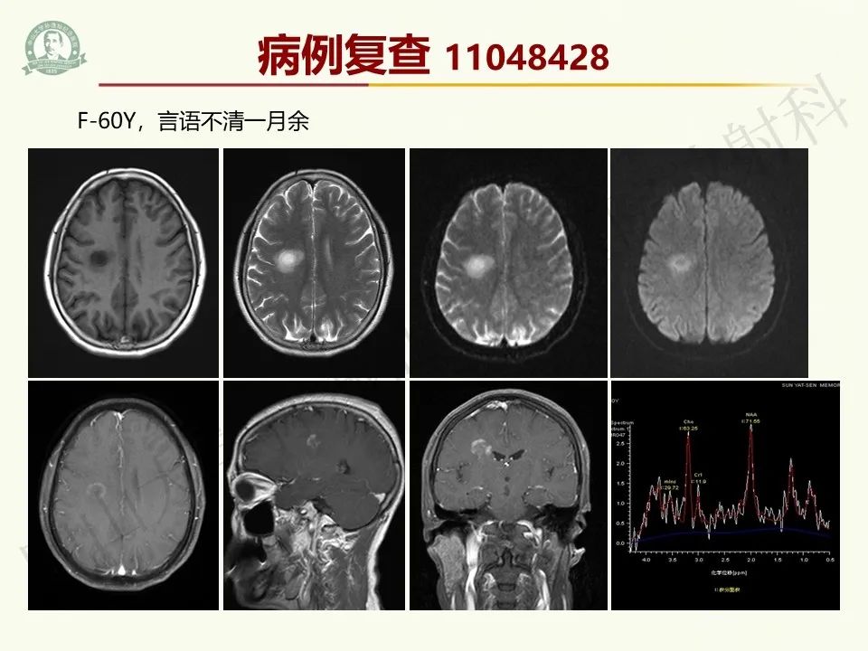 影像PPT - 【病例】脑干脱髓鞘假瘤1例CT及MR影像-37