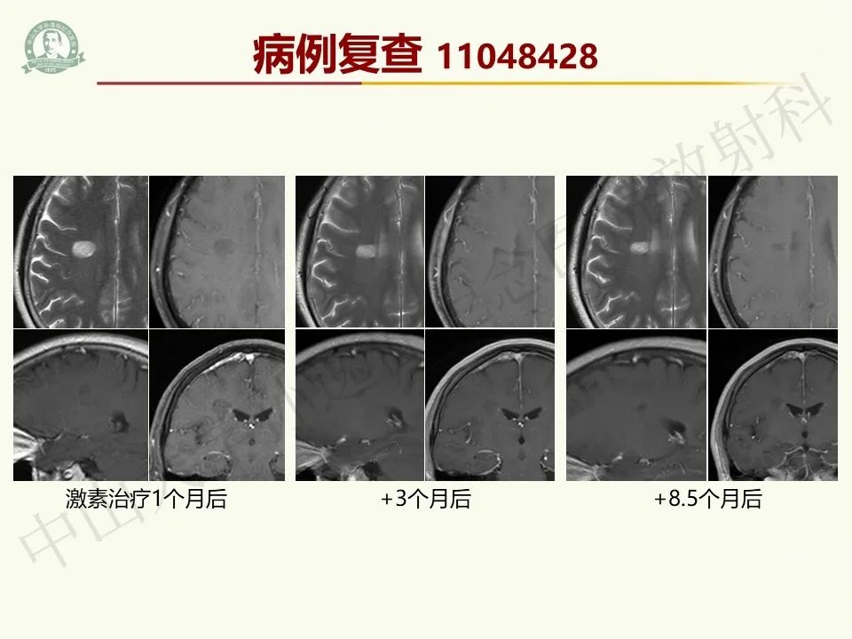 影像PPT - 【病例】脑干脱髓鞘假瘤1例CT及MR影像-38