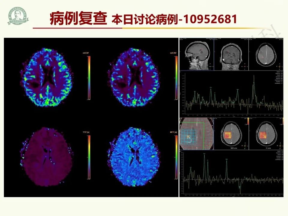 影像PPT - 【病例】脑干脱髓鞘假瘤1例CT及MR影像-36