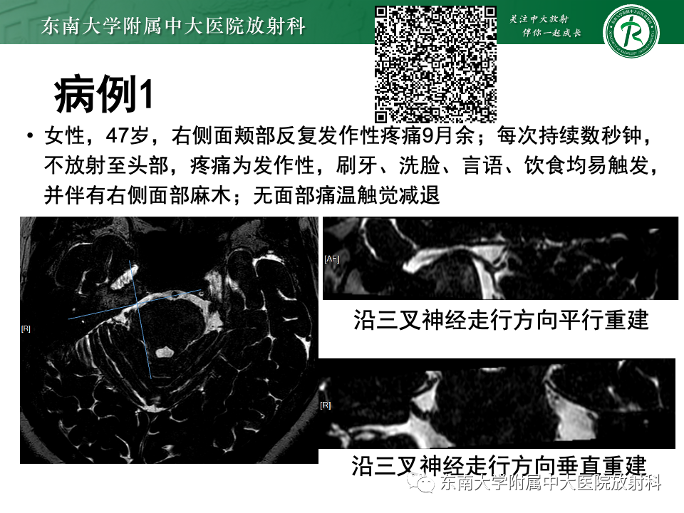 影像PPT - 【PPT】三叉神经痛相关影像诊断与评估-1