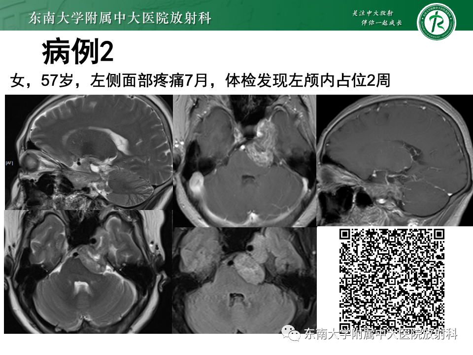 影像PPT - 【PPT】三叉神经痛相关影像诊断与评估-2