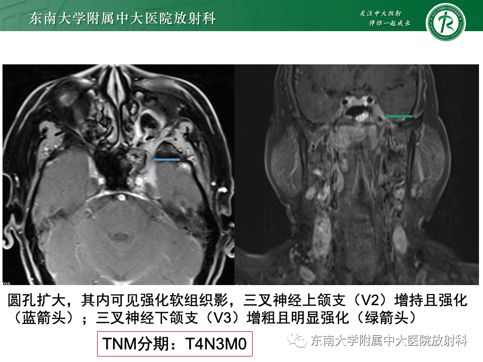 影像PPT - 【PPT】三叉神经痛相关影像诊断与评估-4