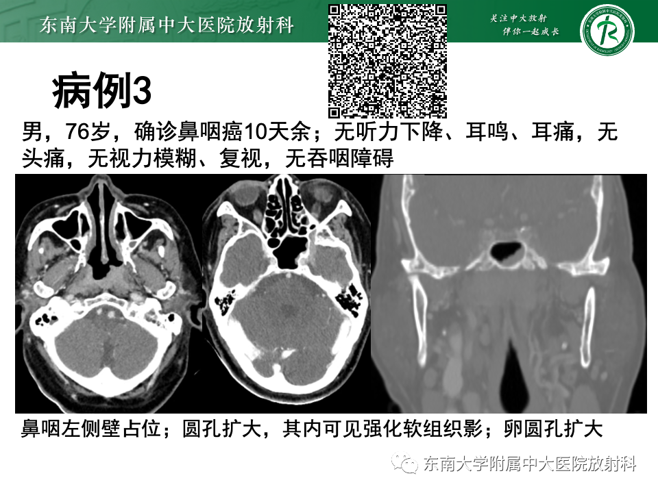 影像PPT - 【PPT】三叉神经痛相关影像诊断与评估-3