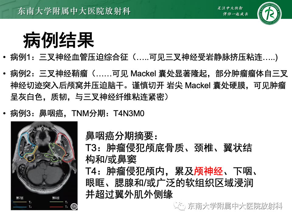 影像PPT - 【PPT】三叉神经痛相关影像诊断与评估-5