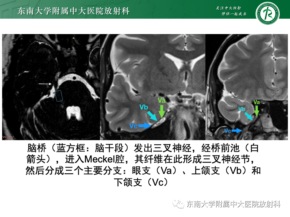 影像PPT - 【PPT】三叉神经痛相关影像诊断与评估-10