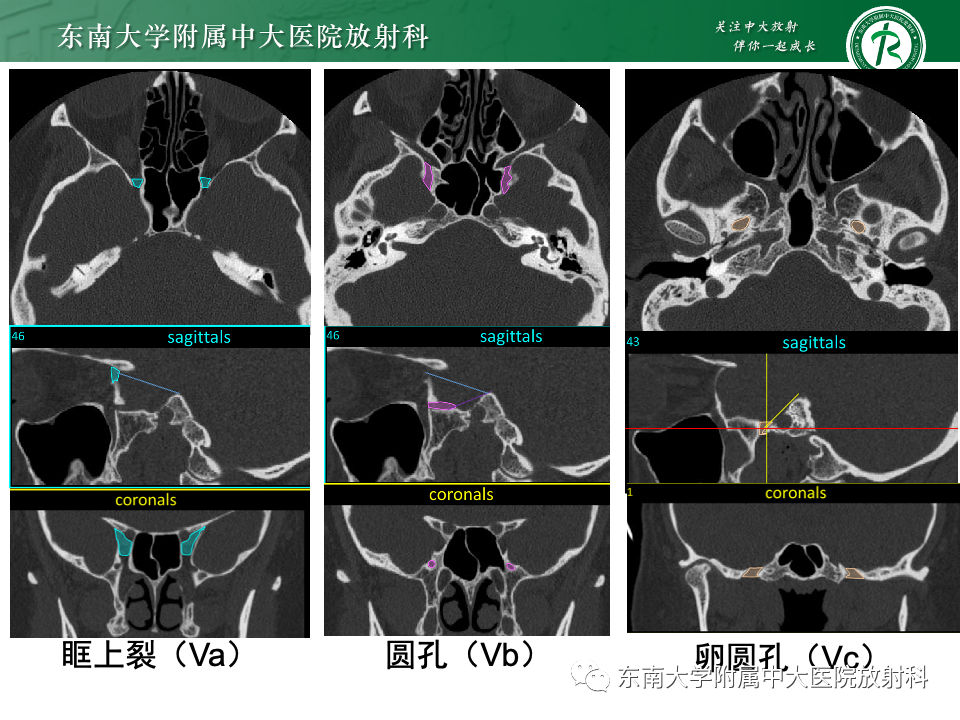 影像PPT - 【PPT】三叉神经痛相关影像诊断与评估-11