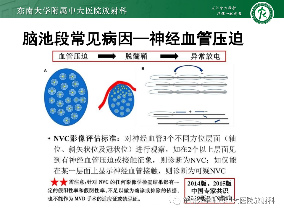 影像PPT - 【PPT】三叉神经痛相关影像诊断与评估-15