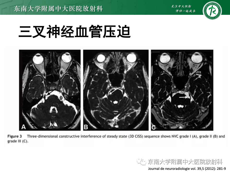 影像PPT - 【PPT】三叉神经痛相关影像诊断与评估-17