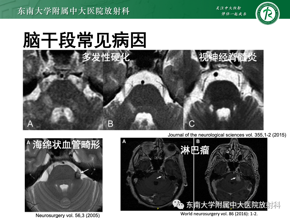 影像PPT - 【PPT】三叉神经痛相关影像诊断与评估-14