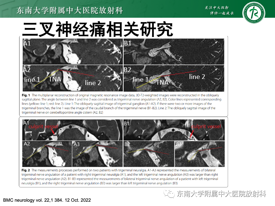 影像PPT - 【PPT】三叉神经痛相关影像诊断与评估-19