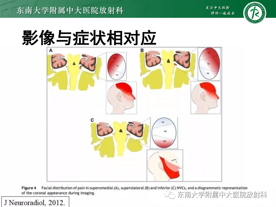 影像PPT - 【PPT】三叉神经痛相关影像诊断与评估-18