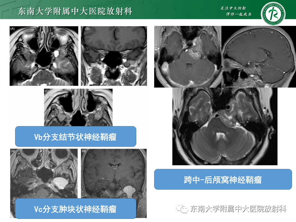 影像PPT - 【PPT】三叉神经痛相关影像诊断与评估-23