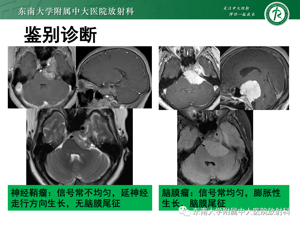 影像PPT - 【PPT】三叉神经痛相关影像诊断与评估-25