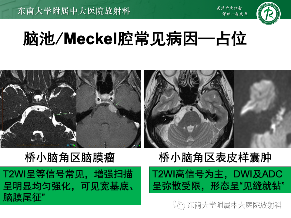 影像PPT - 【PPT】三叉神经痛相关影像诊断与评估-24