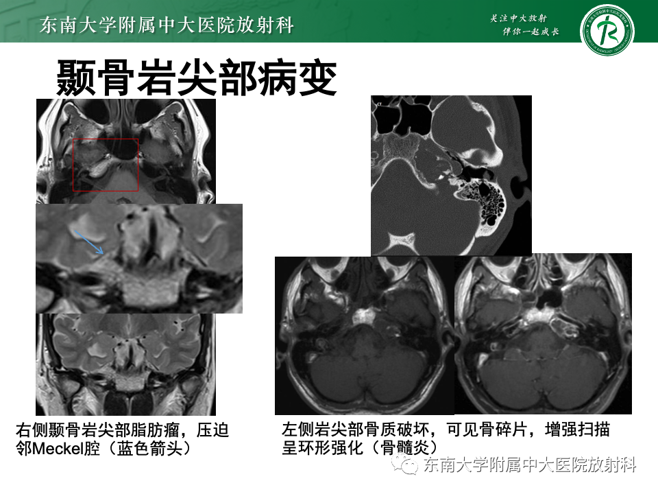 影像PPT - 【PPT】三叉神经痛相关影像诊断与评估-26