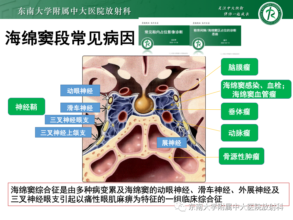 影像PPT - 【PPT】三叉神经痛相关影像诊断与评估-28