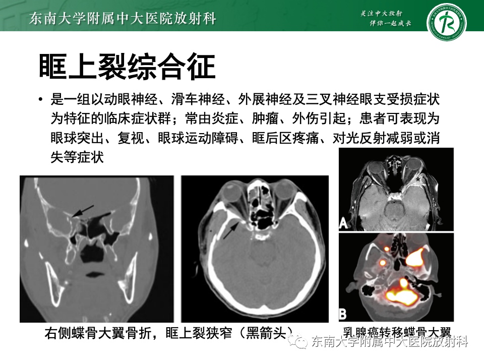 影像PPT - 【PPT】三叉神经痛相关影像诊断与评估-29