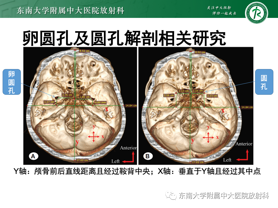 影像PPT - 【PPT】三叉神经痛相关影像诊断与评估-30