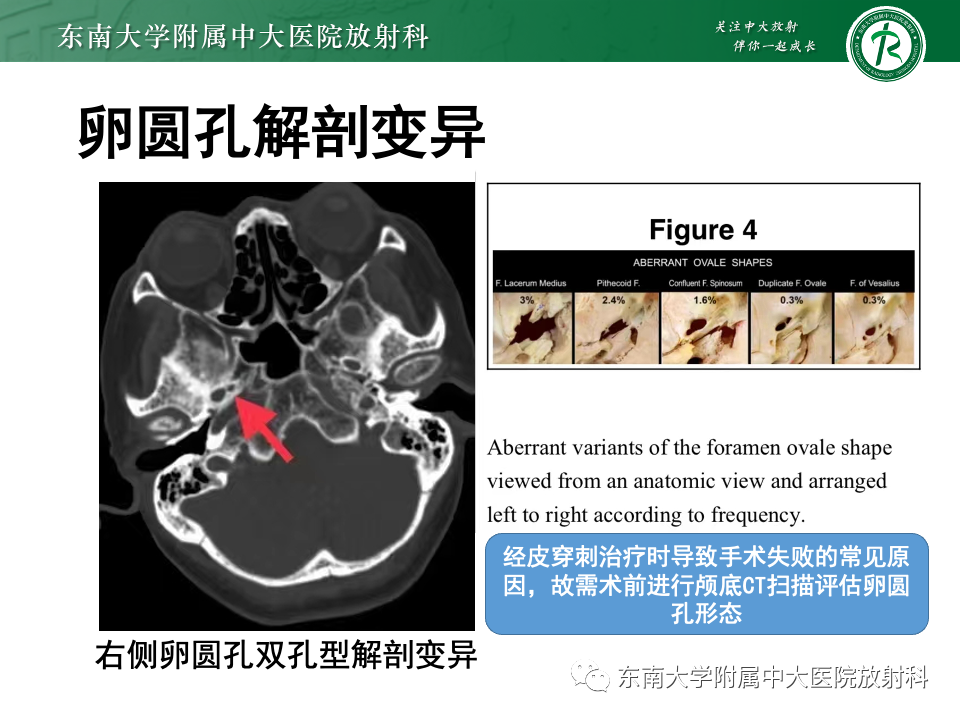 影像PPT - 【PPT】三叉神经痛相关影像诊断与评估-33