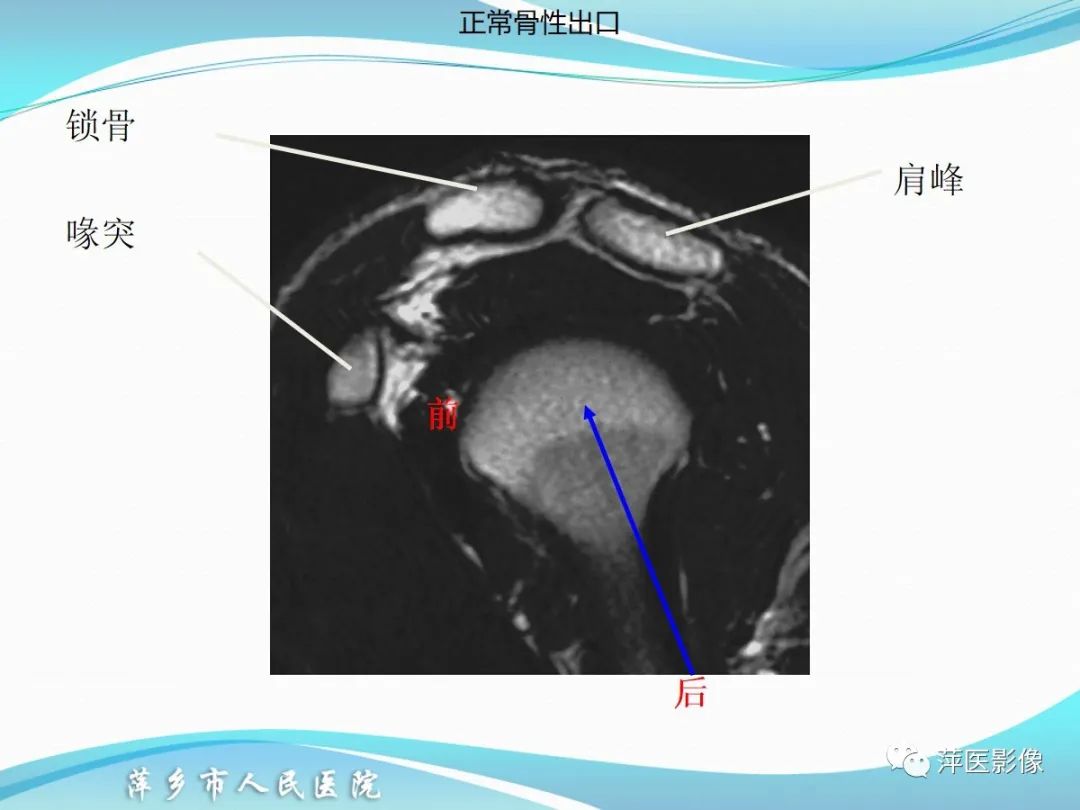 影像PPT - 【PPT】肩关节磁共振读片-8