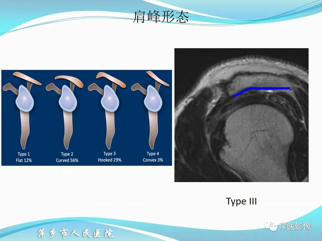 影像PPT - 【PPT】肩关节磁共振读片-12