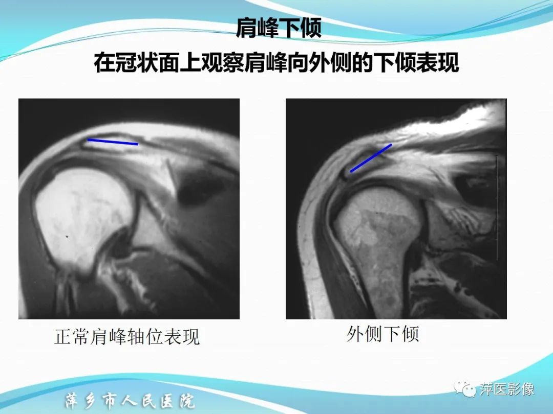 影像PPT - 【PPT】肩关节磁共振读片-14