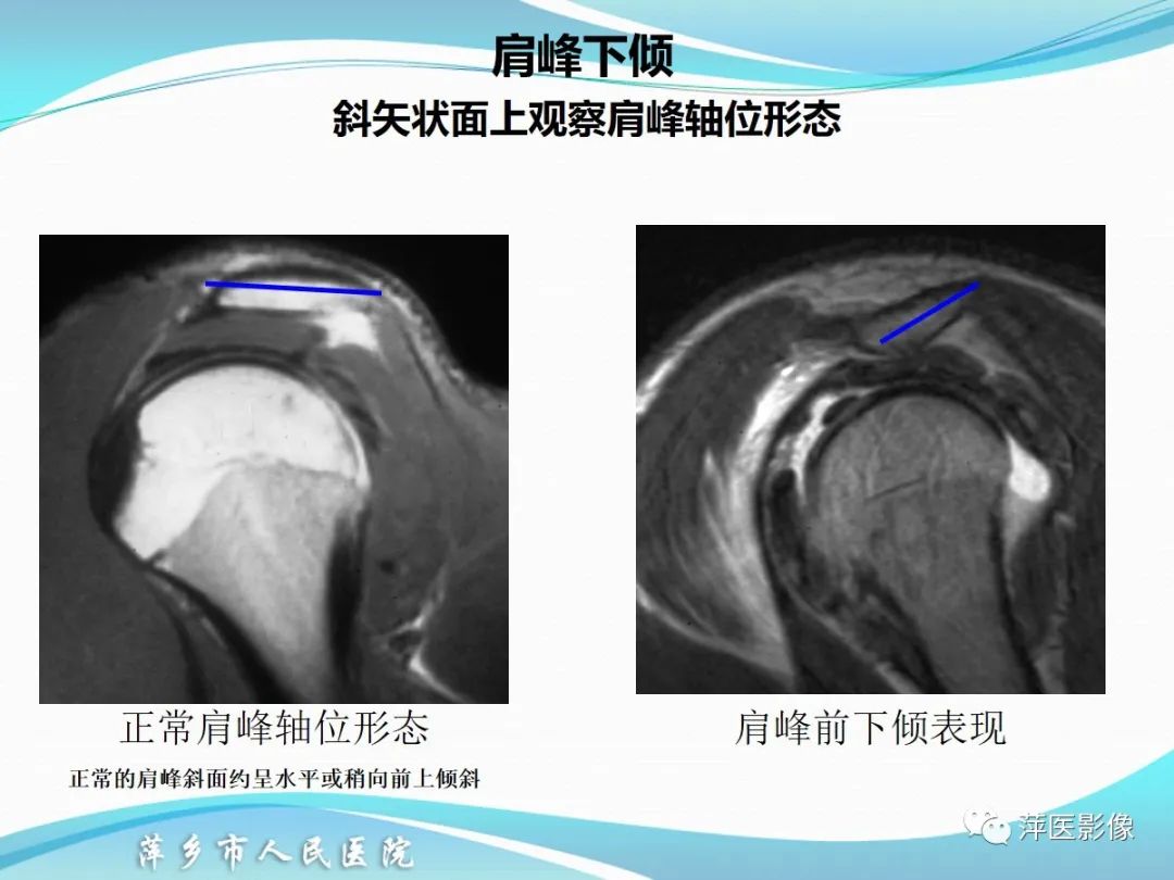 影像PPT - 【PPT】肩关节磁共振读片-13