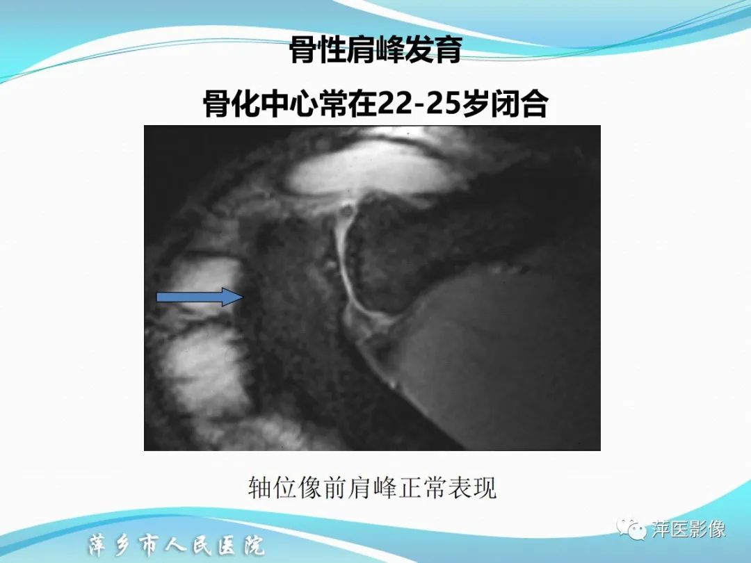 影像PPT - 【PPT】肩关节磁共振读片-15