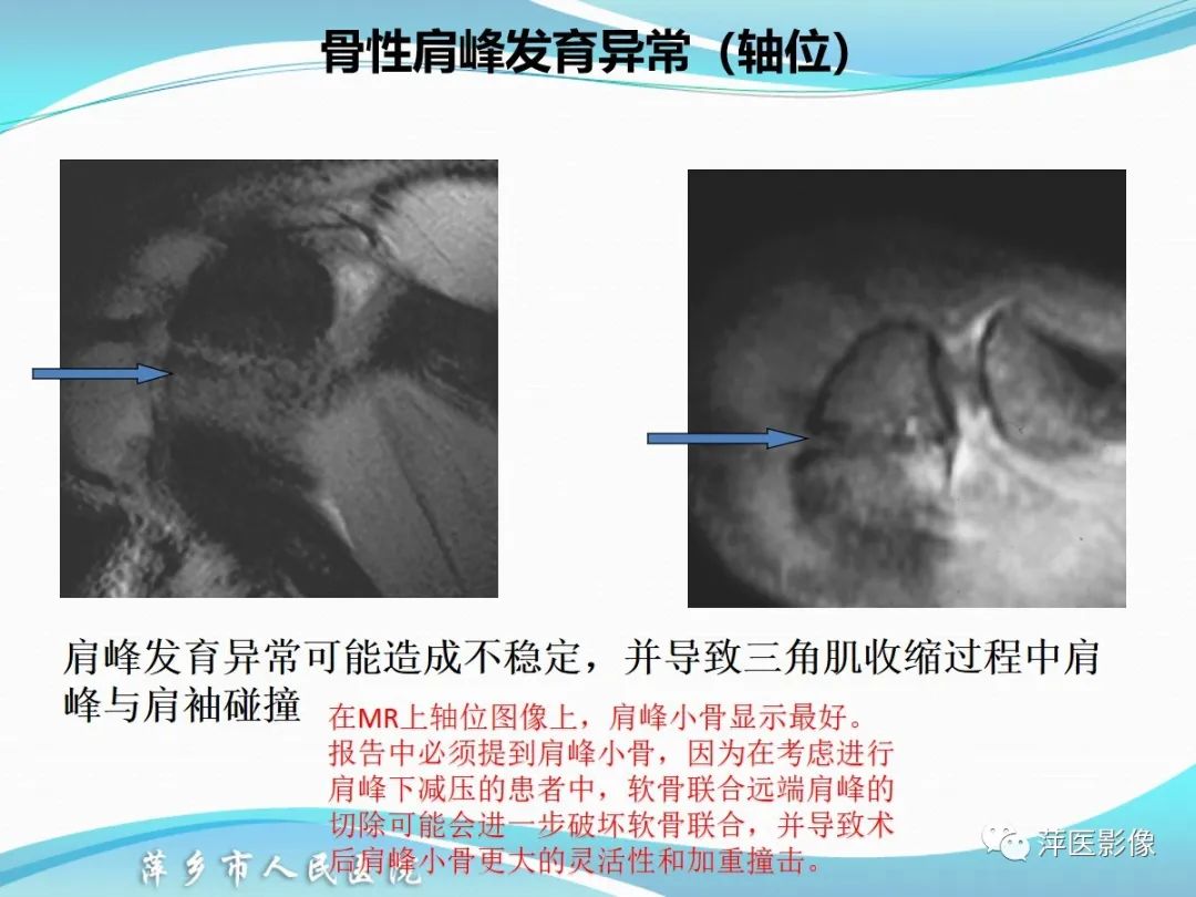 影像PPT - 【PPT】肩关节磁共振读片-16