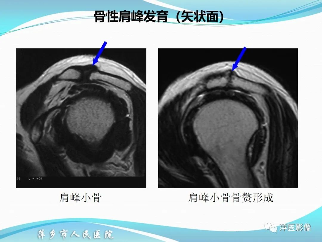影像PPT - 【PPT】肩关节磁共振读片-17