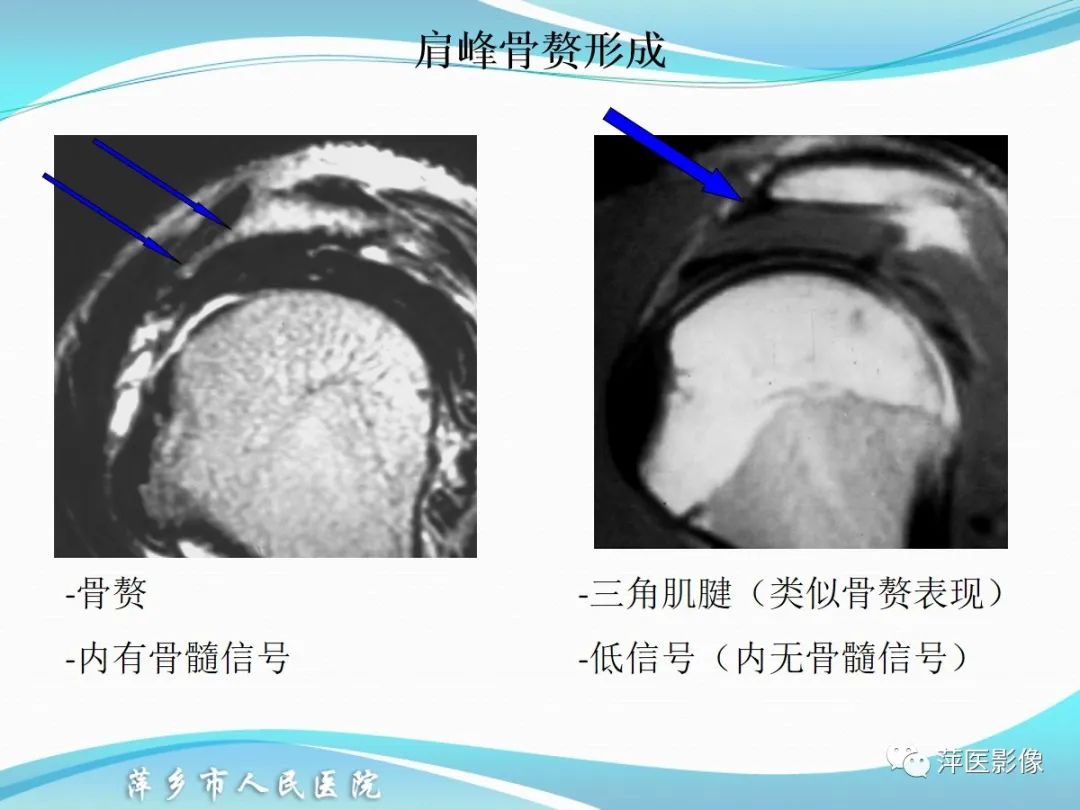 影像PPT - 【PPT】肩关节磁共振读片-18