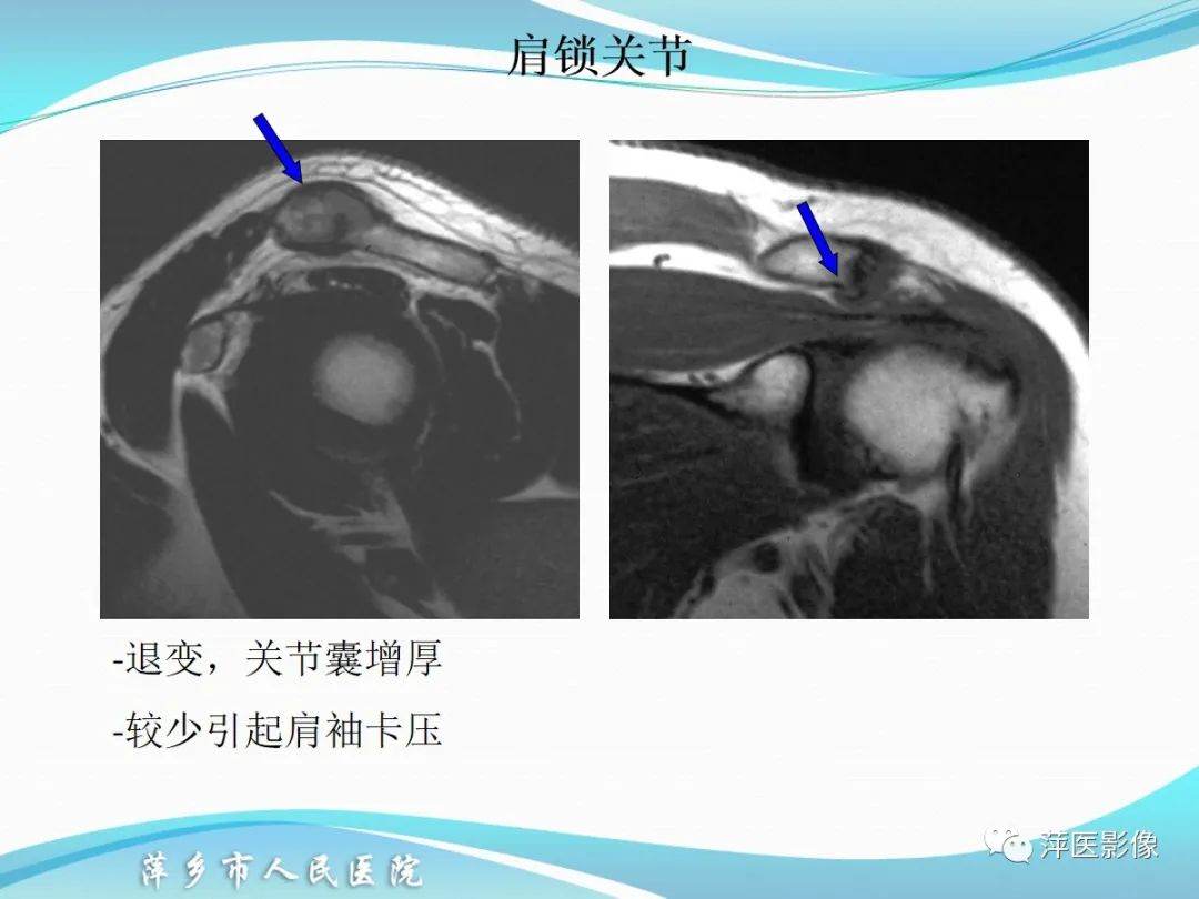 影像PPT - 【PPT】肩关节磁共振读片-20