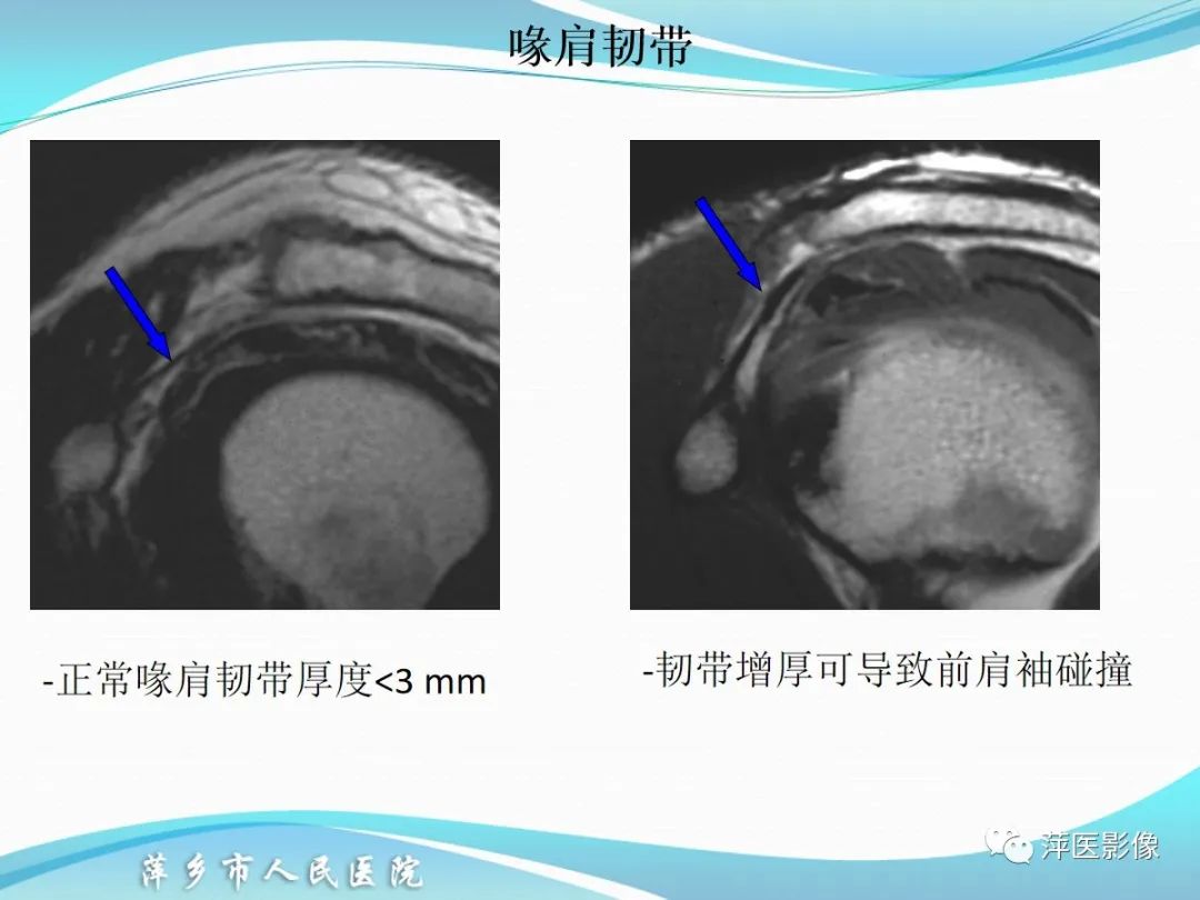 影像PPT - 【PPT】肩关节磁共振读片-21