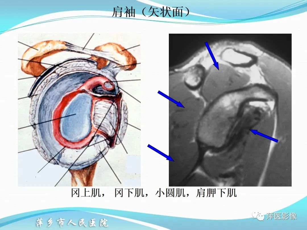 影像PPT - 【PPT】肩关节磁共振读片-25