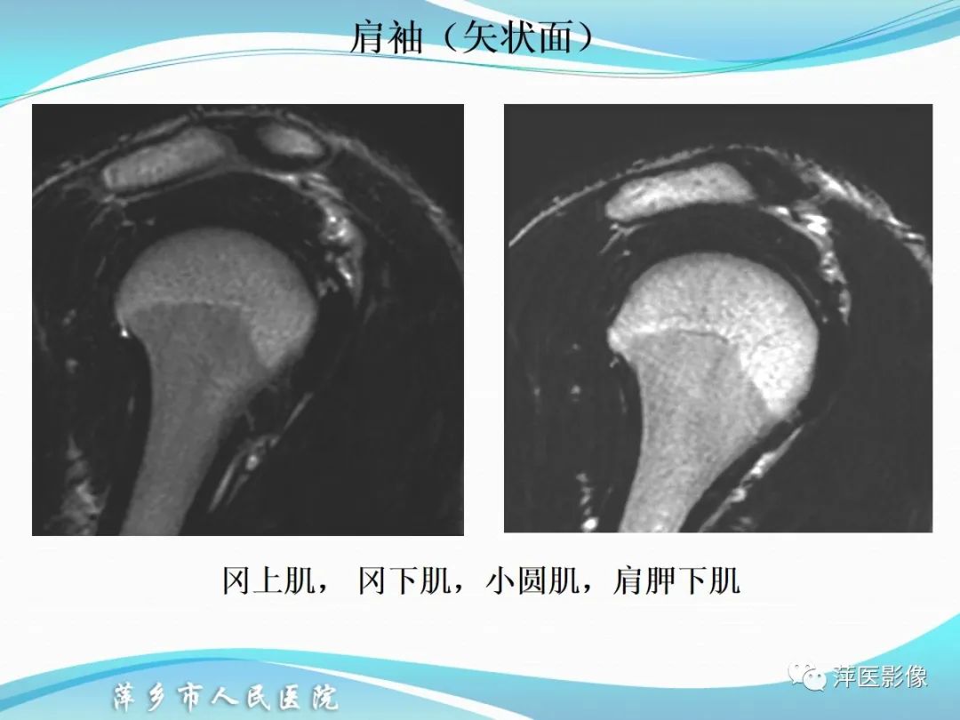 影像PPT - 【PPT】肩关节磁共振读片-26