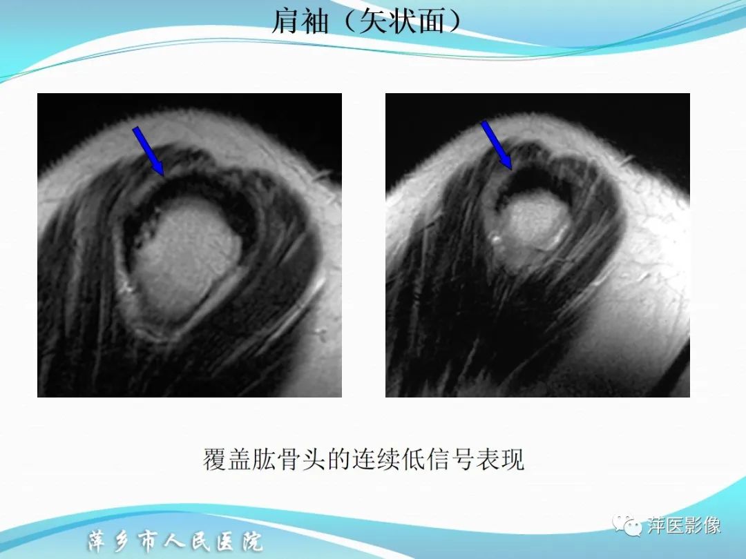 影像PPT - 【PPT】肩关节磁共振读片-27