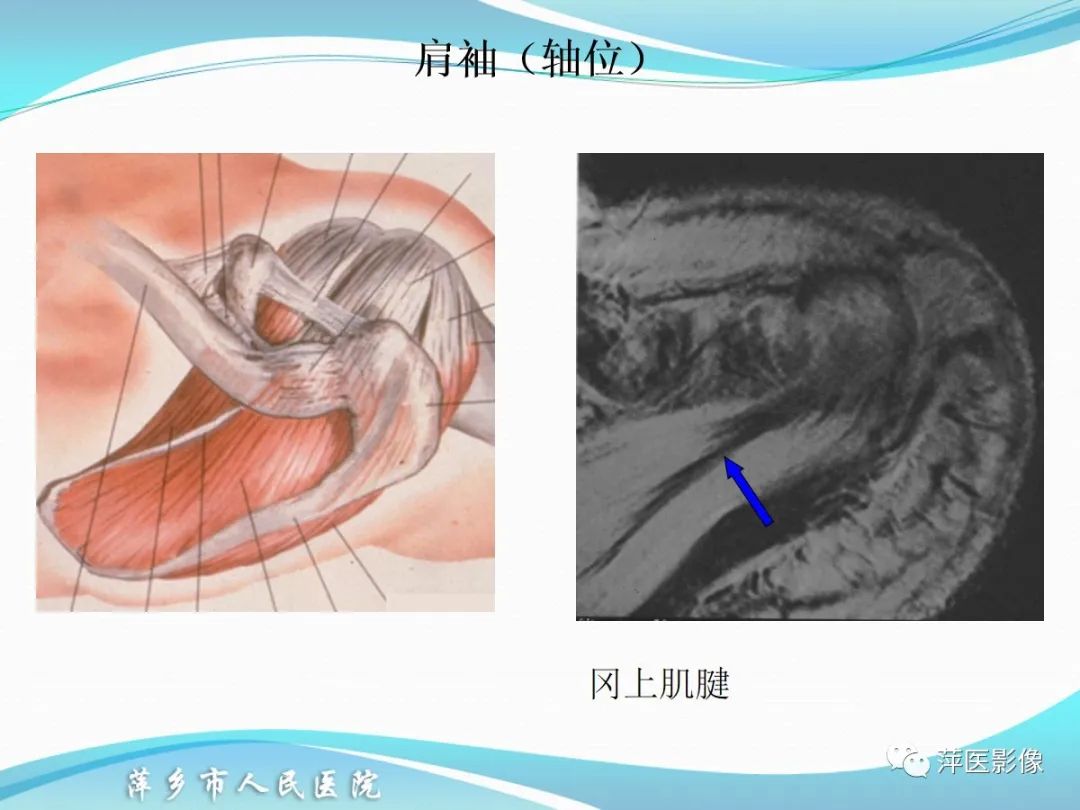 影像PPT - 【PPT】肩关节磁共振读片-28