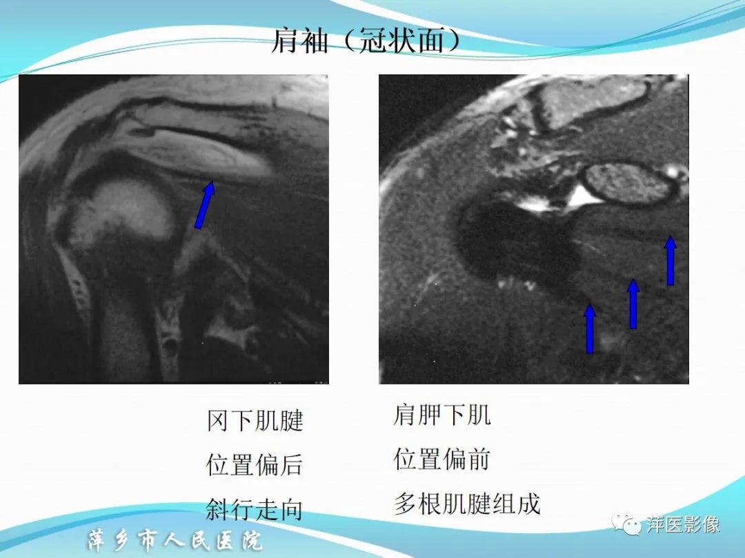 影像PPT - 【PPT】肩关节磁共振读片-31