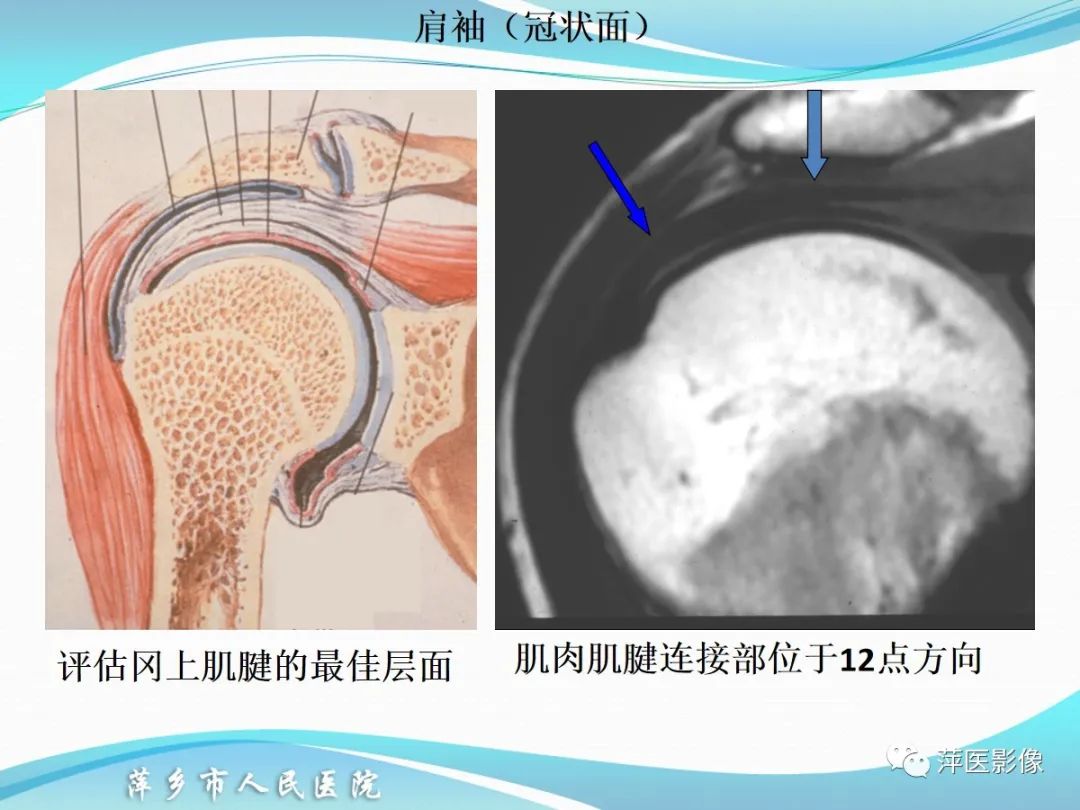 影像PPT - 【PPT】肩关节磁共振读片-30