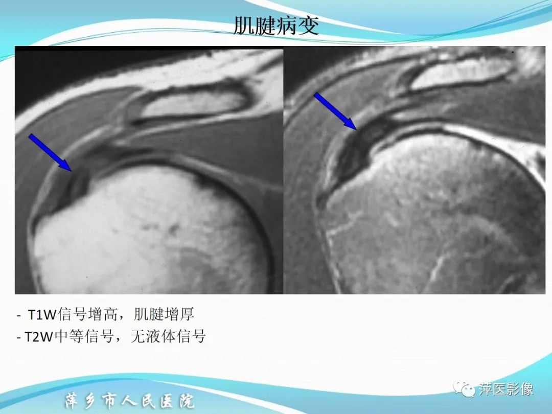 影像PPT - 【PPT】肩关节磁共振读片-33