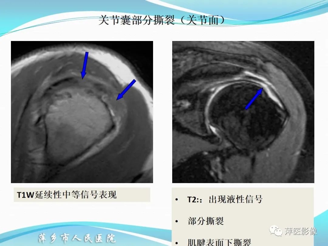影像PPT - 【PPT】肩关节磁共振读片-34